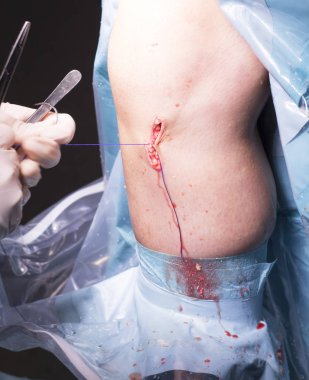 Cerrahi operasyon diz cerrahisi