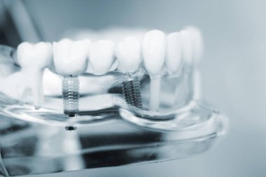 Diş hekimleri diş diş implant