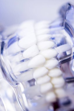 Diş hekimleri diş diş implant