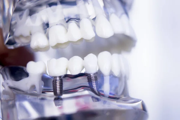 Dentistas implante dental de dientes —  Fotos de Stock