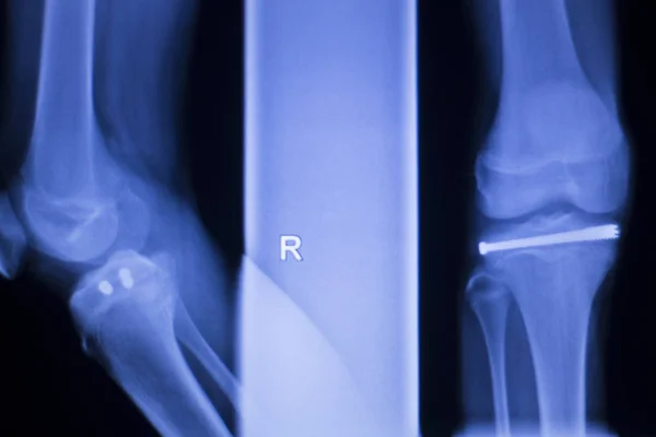 무릎 관절 임 플 란 트 xray — 스톡 사진