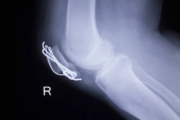 Stawu kolanowego implantu xray — Zdjęcie stockowe
