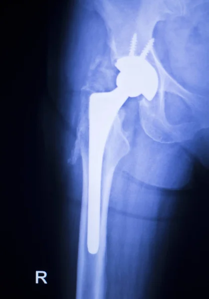 Höftleden ersättare xray — Stockfoto