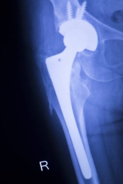 Kalça eklemi replasman xray