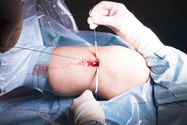 Cerrahi operasyon diz cerrahisi