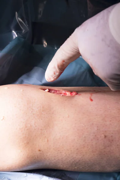 Хирургическая операция на колене — стоковое фото