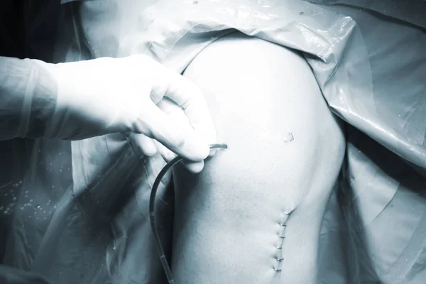 Chirurgische ingreep knie-operatie — Stockfoto