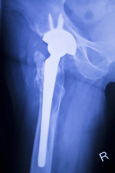 Radiografía de reemplazo de articulaciones de cadera — Foto de Stock
