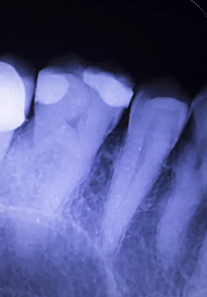 Tooth filling dental xray