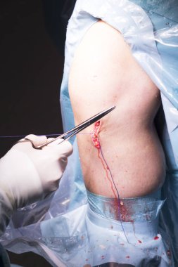 Cerrahi operasyon diz cerrahisi