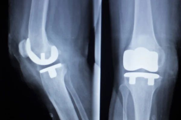 Raio-x do implante articular do joelho — Fotografia de Stock