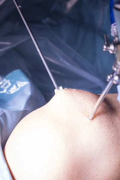 Cirugía quirúrgica Cirugía de rodilla —  Fotos de Stock