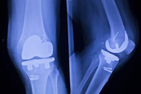 Radiografía de implante articular de rodilla — Foto de Stock