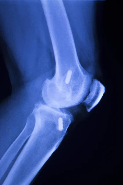 Імплантат колінного суглоба xray — стокове фото
