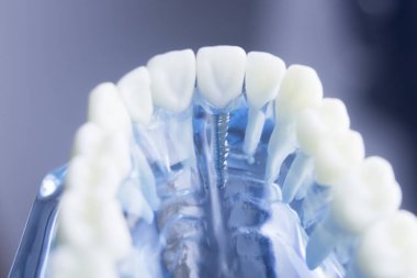 Diş diş diş hekimliği modeli