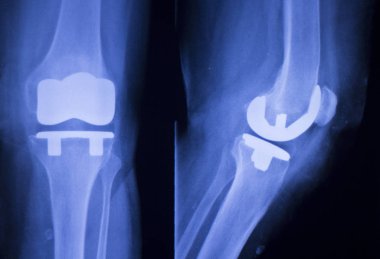 Diz eklem implant xray