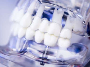 Diş hekimleri diş diş implant