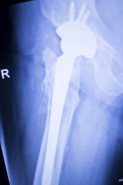Kalça eklemi replasman xray