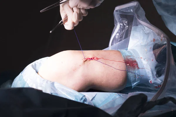 Surgical operation knee surgery — Stock Photo, Image