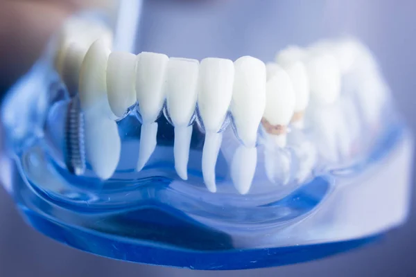 Modelo de placa dental — Foto de Stock