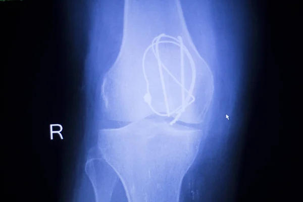 Implant articulaire du genou radiographie — Photo