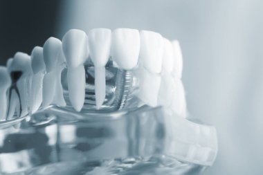 Diş diş kök modeli