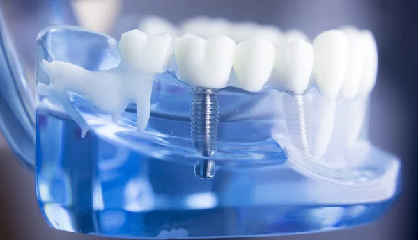 Modello di odontoiatria dentale — Foto Stock