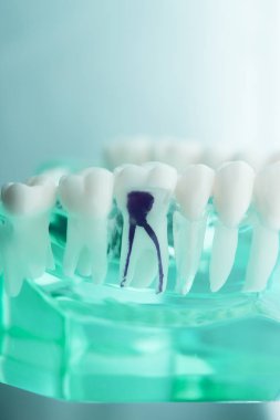 Diş diş diş hekimliği modeli