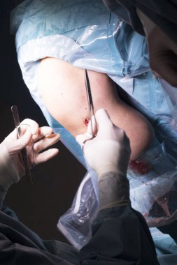 Cerrahi operasyon diz cerrahisi