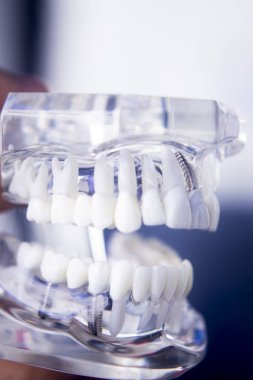 Diş hekimleri diş diş modeli