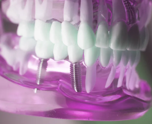 Zahnimplantatschraube aus Titan — Stockfoto