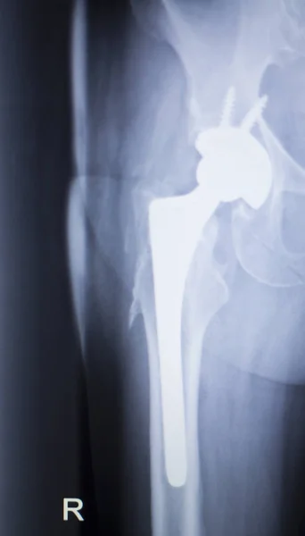 Radiografía de reemplazo de articulaciones de cadera — Foto de Stock