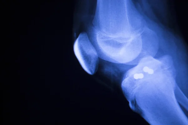 Implant articulaire du genou radiographie — Photo