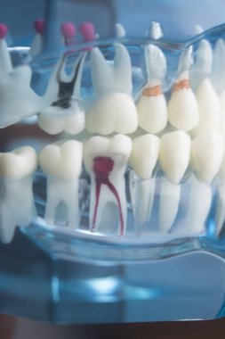 Diş diş diş hekimliği modeli