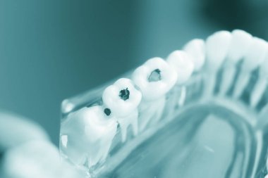 Diş diş çürümesi plak modeli