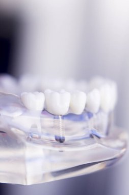 Diş hekimleri diş diş modeli