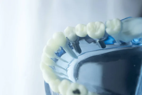 Modèle de dentisterie dentaire — Photo