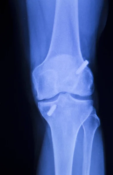 Kniegelenkimplantat Röntgen — Stockfoto