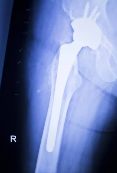 Hüftgelenksersatz Röntgen — Stockfoto