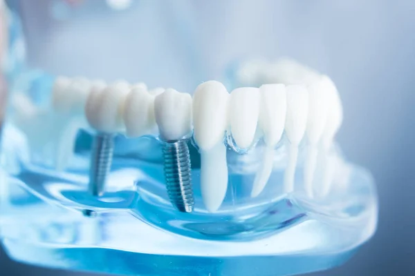 Diş diş diş hekimliği modeli — Stok fotoğraf