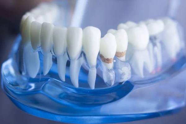 Model plakety zubní zuby — Stock fotografie