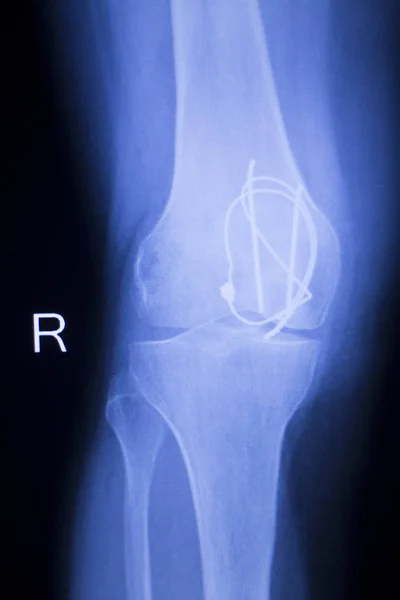 膝关节植入 x 射线 — 图库照片