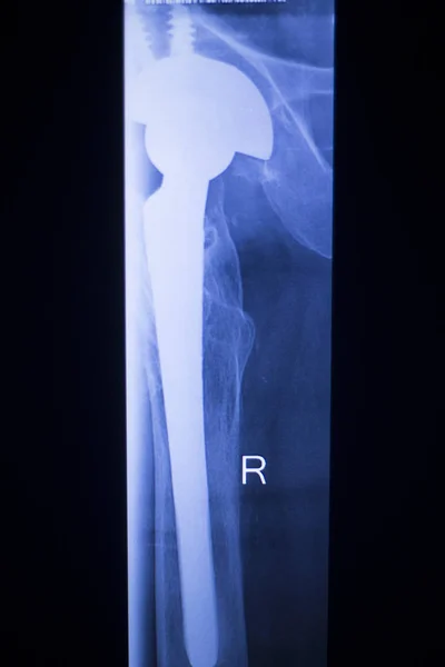 Höftleden ersättare xray — Stockfoto