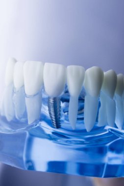 Diş diş diş hekimliği modeli