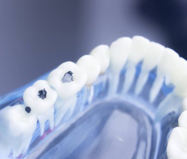 Diş diş çürümesi plak modeli