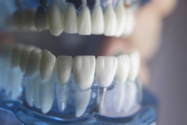 Diş diş diş hekimliği modeli