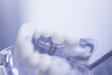 Diş hekimleri diş diş modeli