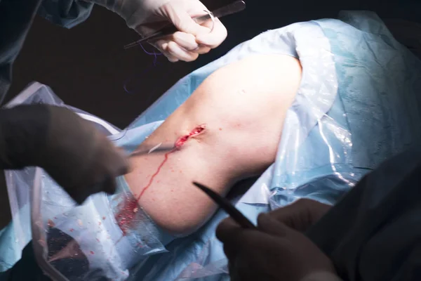 外科手术膝盖手术 — 图库照片