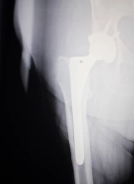 Penggantian sendi pinggul xray — Stok Foto