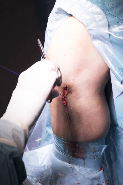 Surgical operation knee surgery — Stock Photo, Image